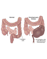 HIRSCHSPRUNG & ANORECTAL MALFORMATION cover