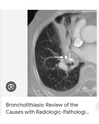 CANDIDIASIS AND HISTOPLASMOSIS cover