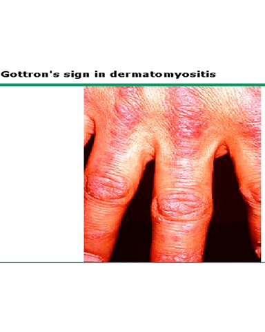 INFLAMMATORY MYOPATHIES cover