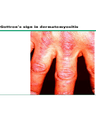 INFLAMMATORY MYOPATHIES cover