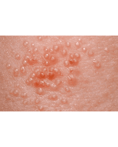 HERPES VIRUS INFECTIONS cover