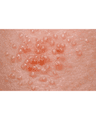 HERPES VIRUS INFECTIONS cover