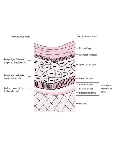 PEMPHIGUS VULGARIS PRIMARY BLISTERING DISEASES cover